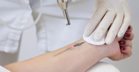 Удаление татуировки лазером: как происходит и от чего зависит результат