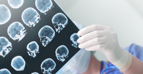 Искусственный интеллект сможет распознавать болезнь Альцгеймера
