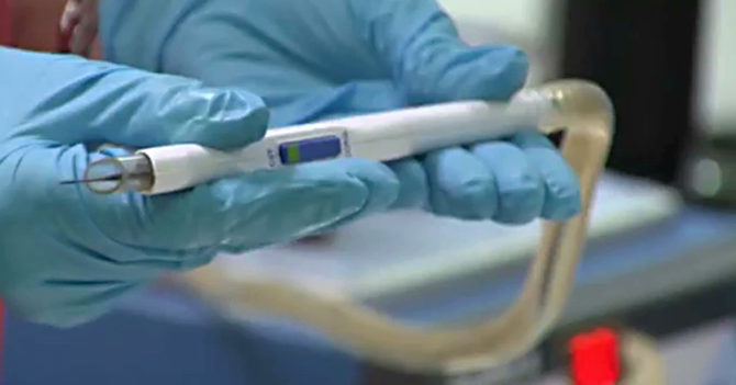 Хірургічний ніж iKnife за декілька секунд виявляє рак шийки матки