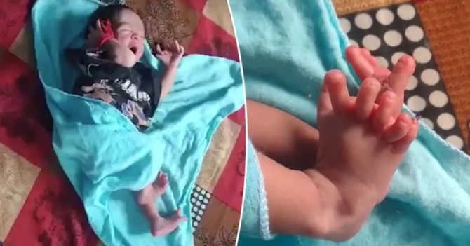В Індії народилася дитина з 26 пальцями рук і ніг: фото